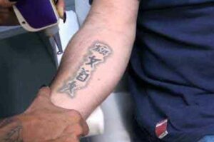 tatoeage-verwijderen-2