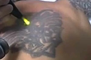 tatoeage-verwijderen-3